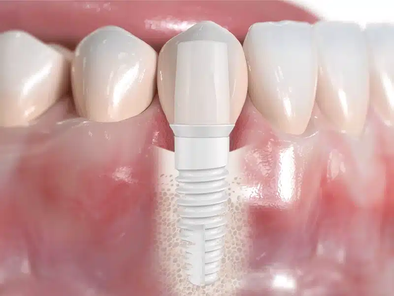 Ceramic implant