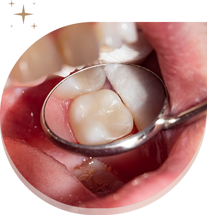 Metal free cosmetic dentistry - renew wellness dentistry