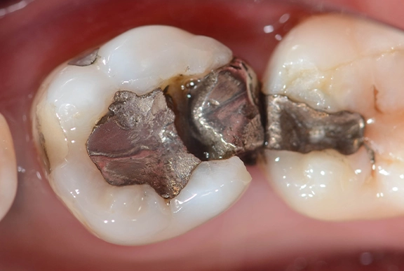 Safe Mercury Amalgam Removal Dentist New Orleans Safe mercury amalgam removal