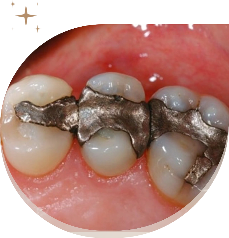 Safe mercury removal - renew wellness dentistry