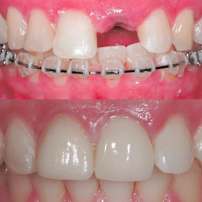 Before and after implant placement