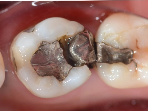 Dangers of mercury fillings are mercury fillings bad