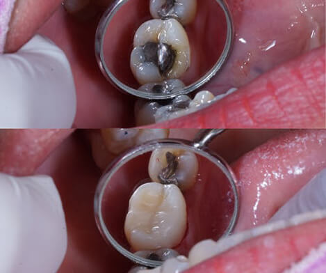 Mercury filling removal mercury filling removal
