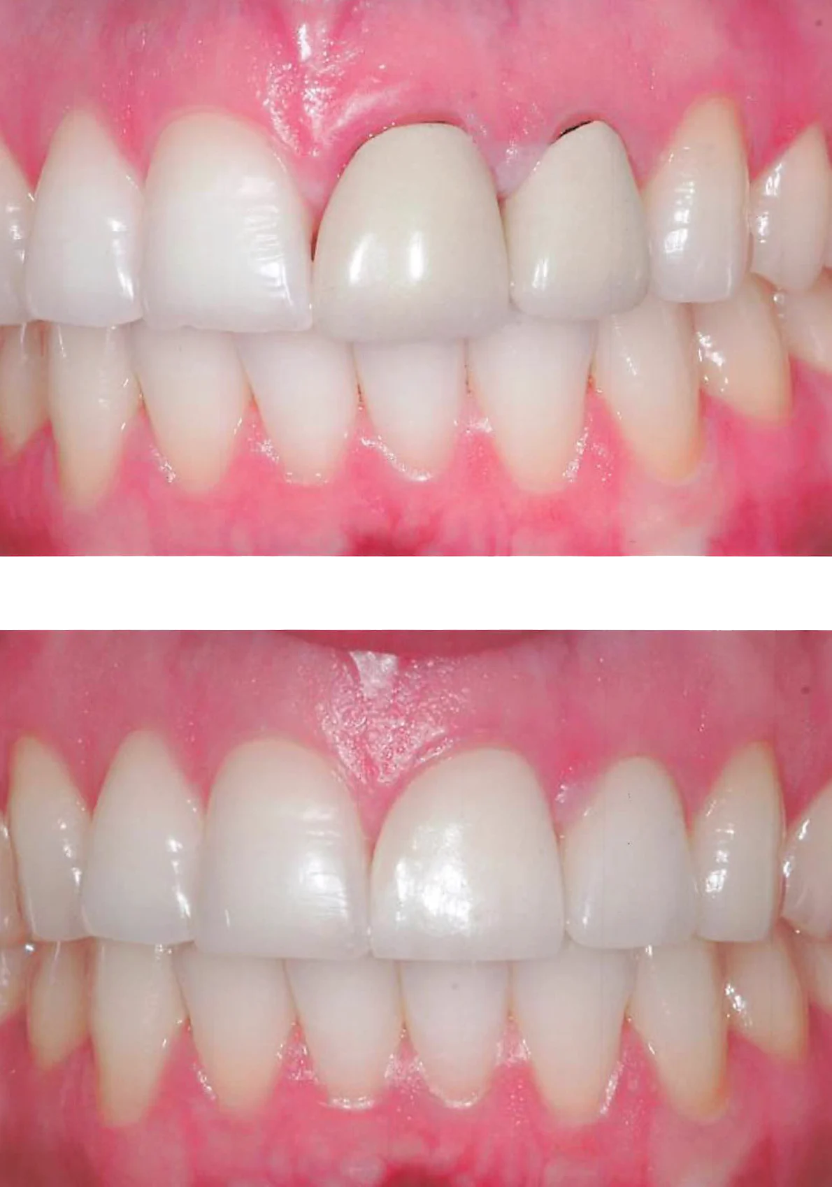 Metal free dentistry