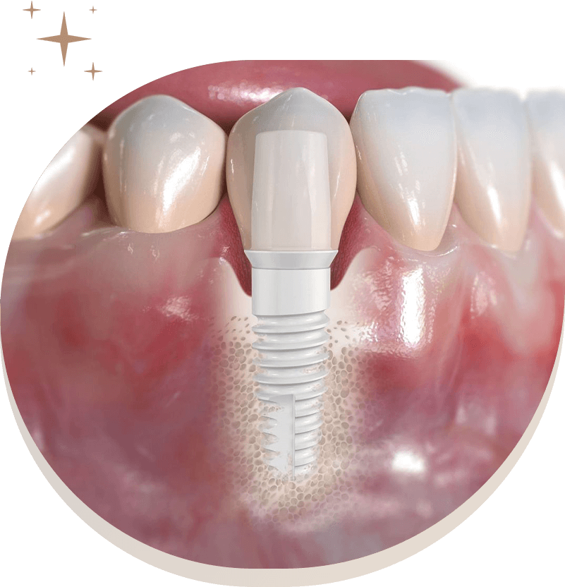 Philadelphia kensington ma img implant