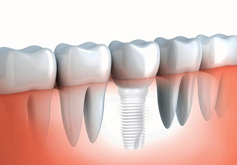 Zirconia implants